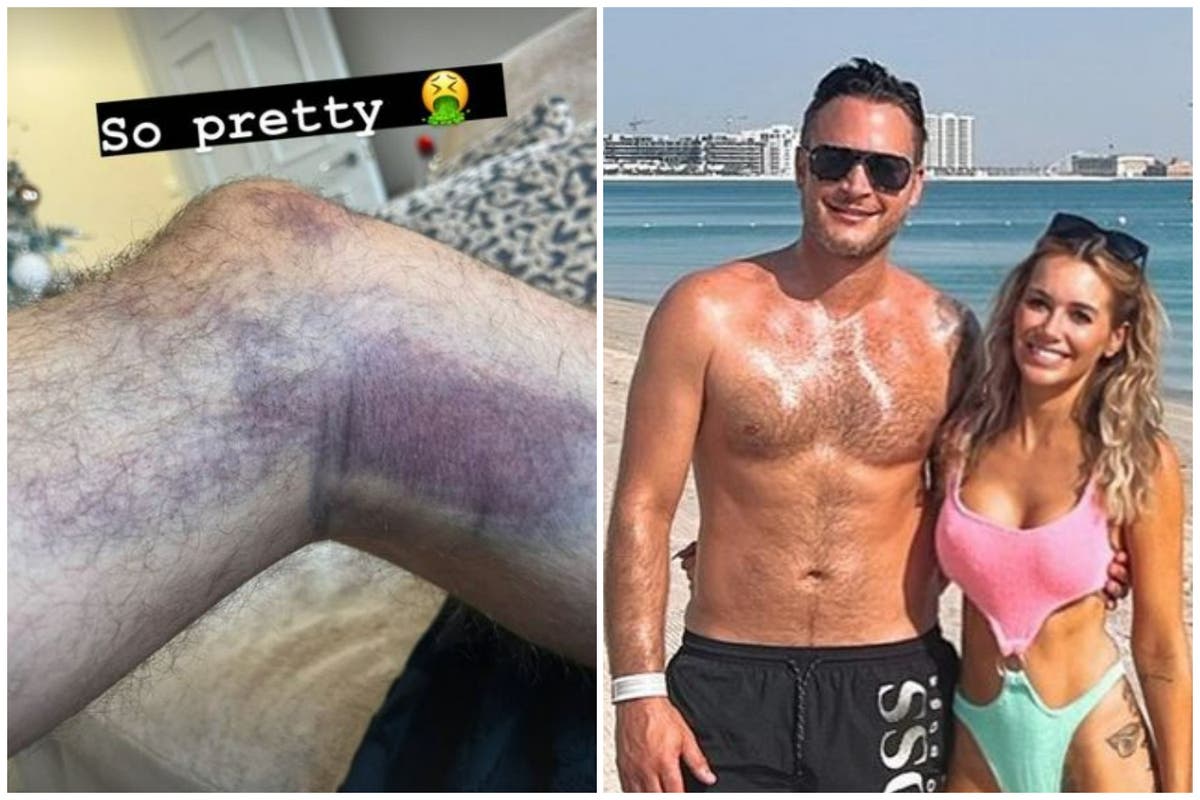 Gary Lucy reveals nasty bruises after surviving Boxing Day car crash